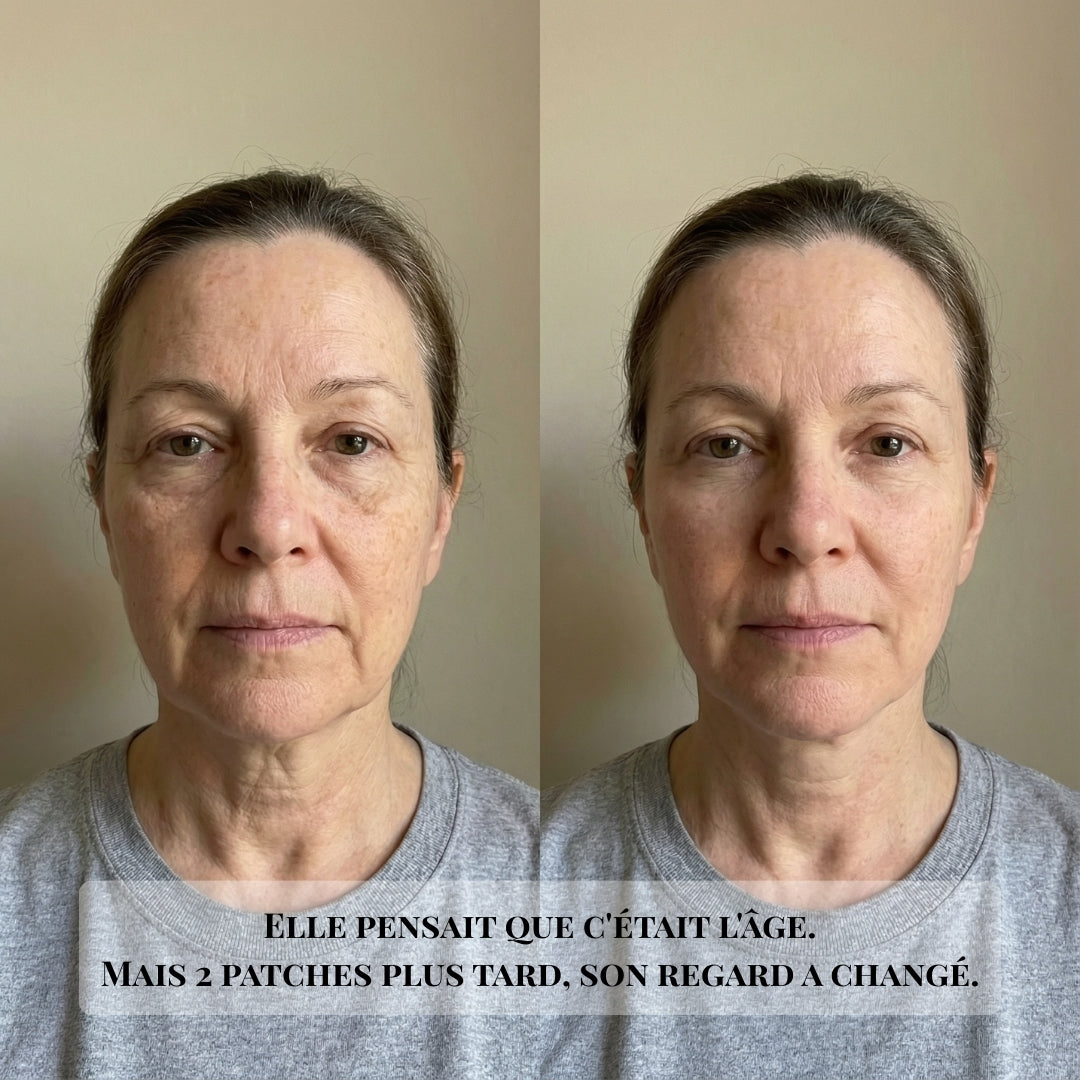 Patchs DermaGlow — La solution quand les crèmes  ne fonctionnent plus